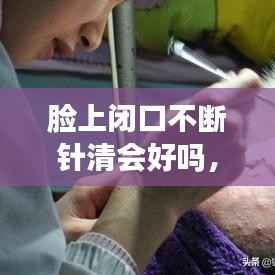 脸上闭口不断针清会好吗,脸上针清闭口要多少次能清完