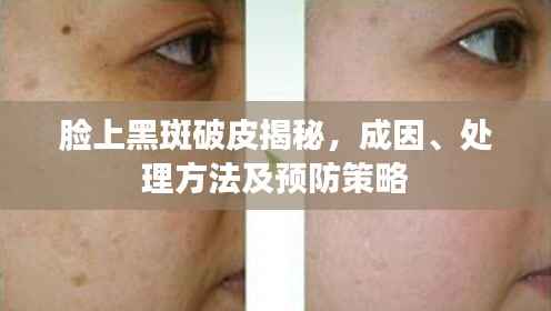 脸上黑斑破皮揭秘,成因、处理方法及预防策略