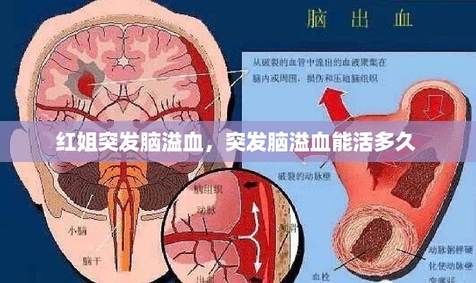 红姐突发脑溢血,突发脑溢血能活多久